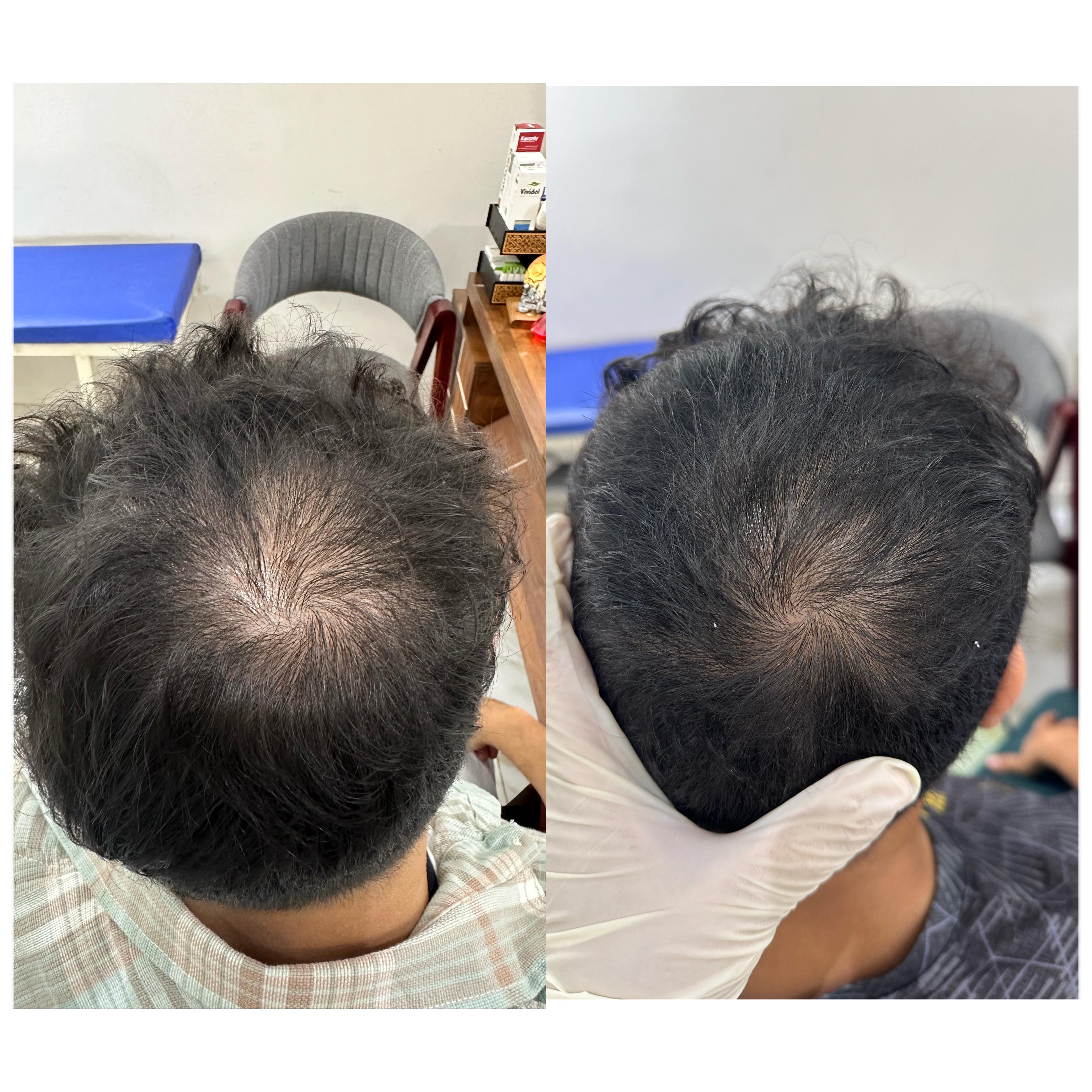 نتيجه جلسات الخلايا الجذعية قبل وبعد